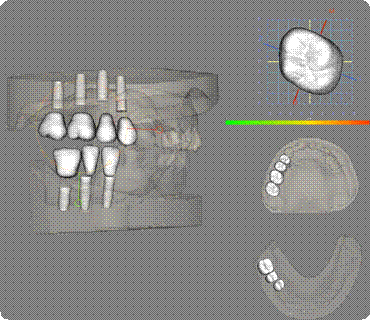 Description: Implant planning
